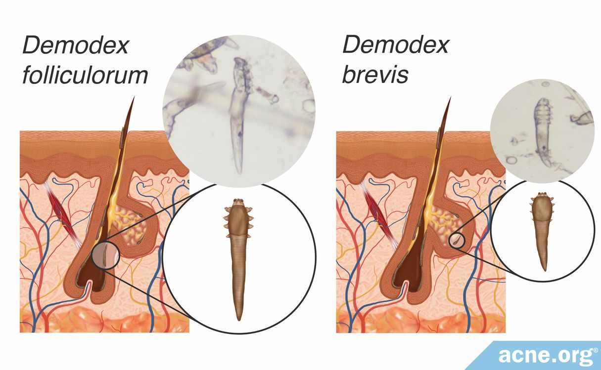 Демодекоз (подкожный клещ) - симптомы, лечение и профилактика